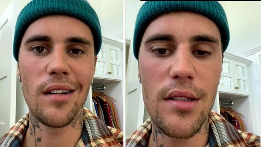 Justin Beiber says right side of his face is paralysed after virus attack